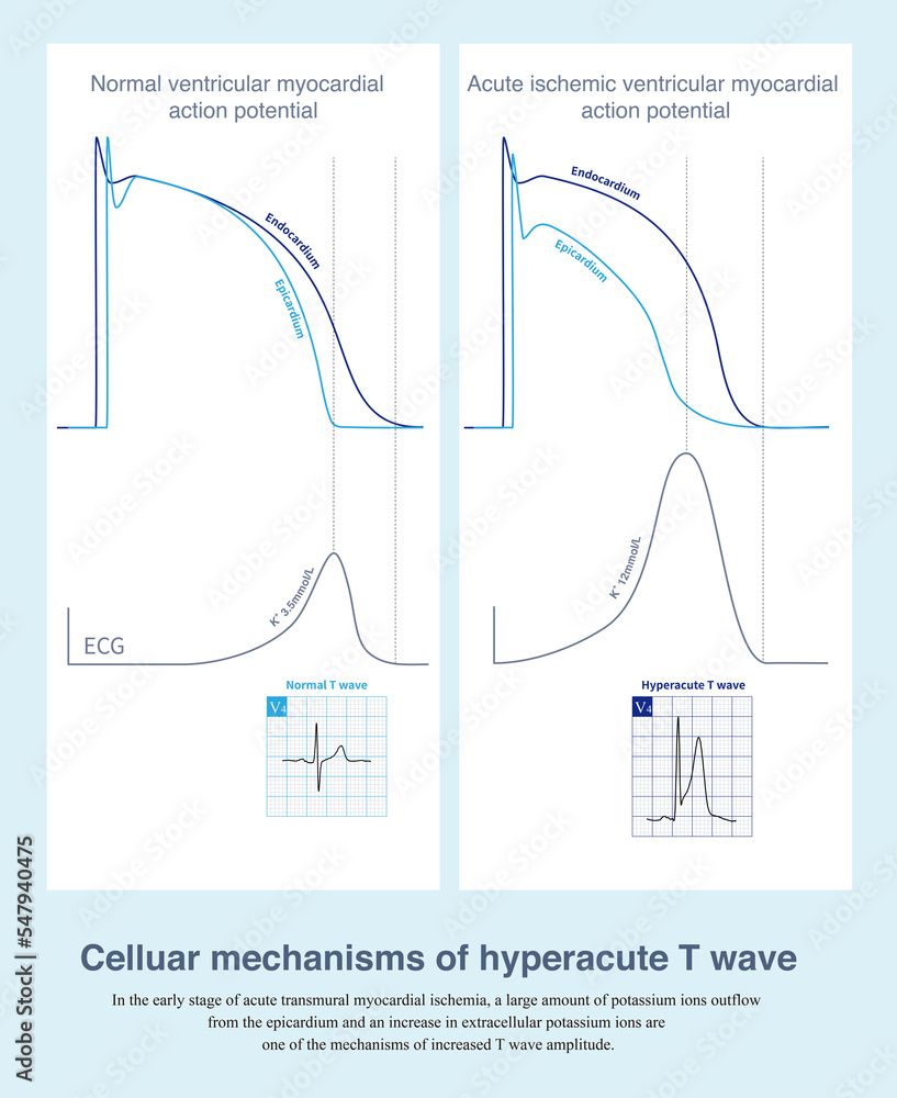 In acute transmural myocardial ischemia, epicardial potassium outflow ...
