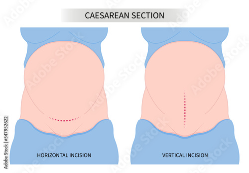 Women tummy belly scar of Pregnancy Newborn Baby birth prolapse umbilical cord twins womb Spinal Anaesthesia block uterus infant Fetal fetus mother Labour feet high blood pressure preeclampsia pain
