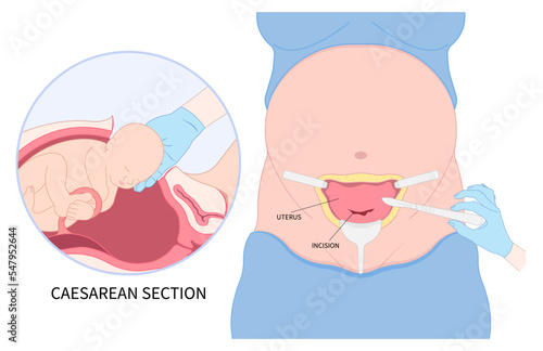 Newborn Baby birth prolapse umbilical cord twins Pregnancy scar womb tummy women Spinal Anaesthesia block uterus infant Fetal fetus mother belly Labour feet high blood pressure preeclampsia pain photo