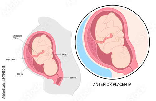 Lateral baby placenta location of pregnancy back fetus Labour death uterine wall intrauterine gender prediction growth restriction prenatal care photo