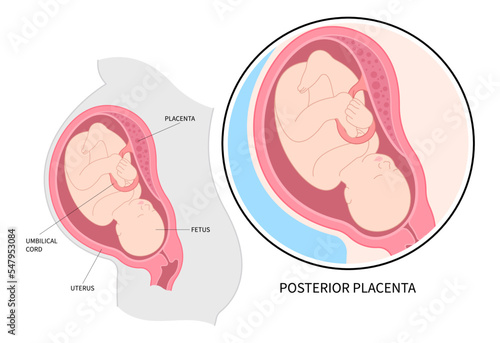 uterine wall growth restriction Lateral baby placenta location of pregnancy back fetus Labour death intrauterine gender prediction prenatal care