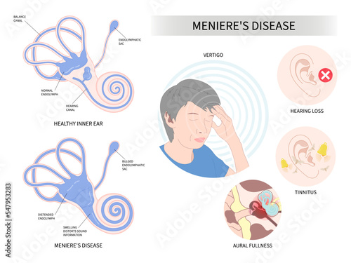 Symptoms of The Meniere's disease of sound in stuffy ear hear ringing roaring buzzing loss of balance dizzy spells pressure headache photo