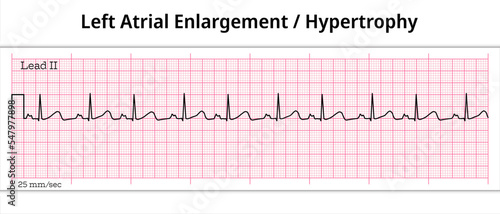 ECG Left Atrial Enlargement - 8 Second ECG Paper - Left Atrial Hypertrophy
