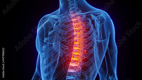 3D rendered Medical Illustration of Male Anatomy - Inflamed Thoracic Spine.