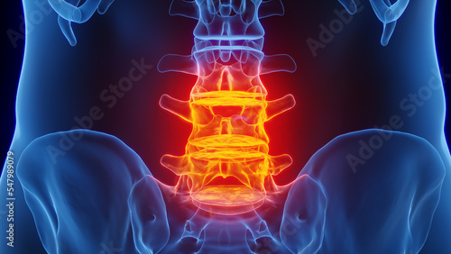 Foto 3D rendered Medical Illustration of Male Anatomy - Inflamed Lumbar Spine