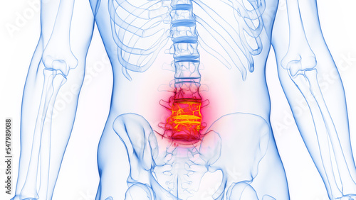 Canvas Print 3D rendered Medical Illustration of Male Anatomy - Inflamed Lumbar Spine
