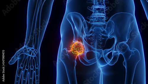 Fotografie 3D rendered Medical Illustration of Male Anatomy - Inflamed Hip Joint undergoing healing