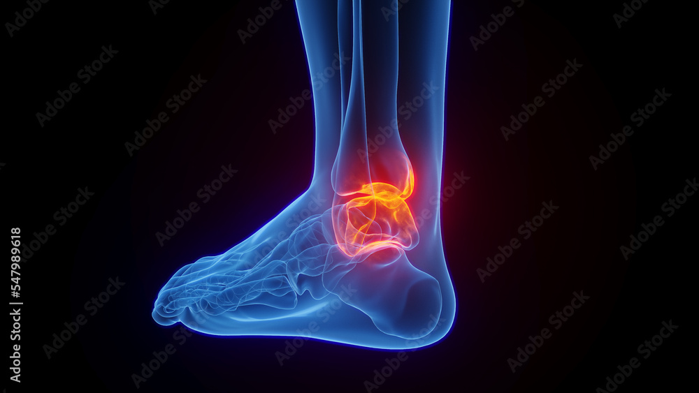 3D rendered Medical Illustration of Male Anatomy - Inflamed Ankle. Plain Black Background. 3D rendered Medical Illustration of Male Anatomy - Inflamed Ankle. Plain Black Background.