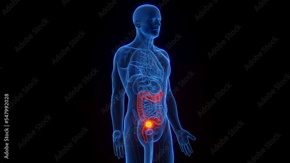 3D Rendered Medical Illustration of Male Anatomy - Rectal Cancer. 3D Rendered Medical Illustration of Male Anatomy - Rectal Cancer.
