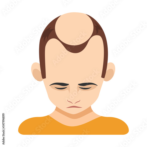 Four stage of alopecia in men vector illustration. Top of male head with bald spot on scalp isolated on white background. Health, hair loss or treatment concept