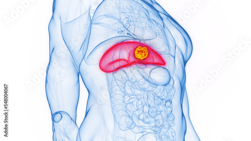 3D rendered Medical Illustration of Male Anatomy - Liver Cancer. photo