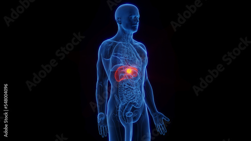 3D Rendered Medical Illustration of Male Anatomy - Liver Cancer.
