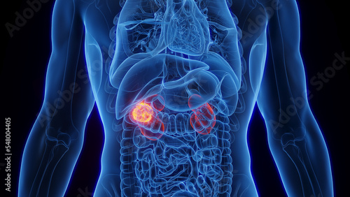 3D Rendered Medical Illustration of Male Anatomy - Kidney Cancer.