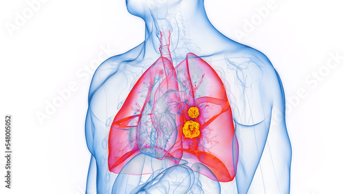 3D rendered Medical Illustration of Male Anatomy - Lung Cancer. photo