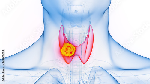 3D rendered Medical Illustration of Male Anatomy - Thyroid Cancer.