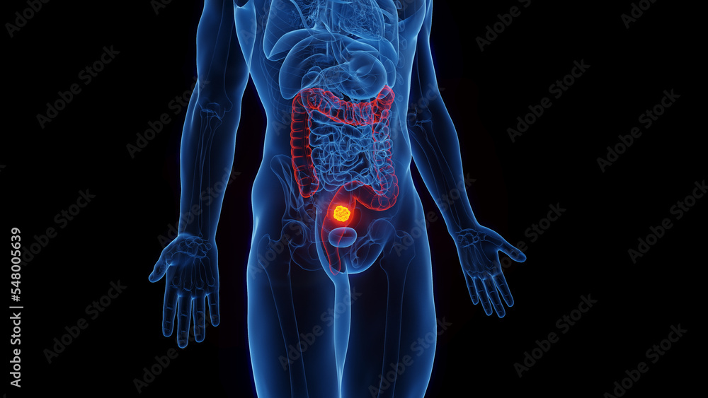 3D rendered Medical Illustration of Male Anatomy - Rectal Cancer. 3D rendered Medical Illustration of Male Anatomy - Rectal Cancer.