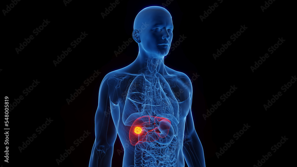 3D Rendered Medical Illustration of Male Anatomy - Liver Cancer. 3D Rendered Medical Illustration of Male Anatomy - Liver Cancer.
