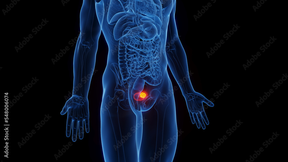 3D Rendered Medical Illustration of Male Anatomy - Urinary Bladder Cancer. 3D Rendered Medical Illustration of Male Anatomy - Urinary Bladder Cancer.