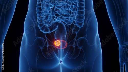 Tela 3D Rendered Medical Illustration of Male Anatomy - Urinary Bladder Cancer