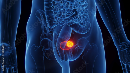 3D Rendered Medical Illustration of Male Anatomy - Urinary Bladder Cancer.