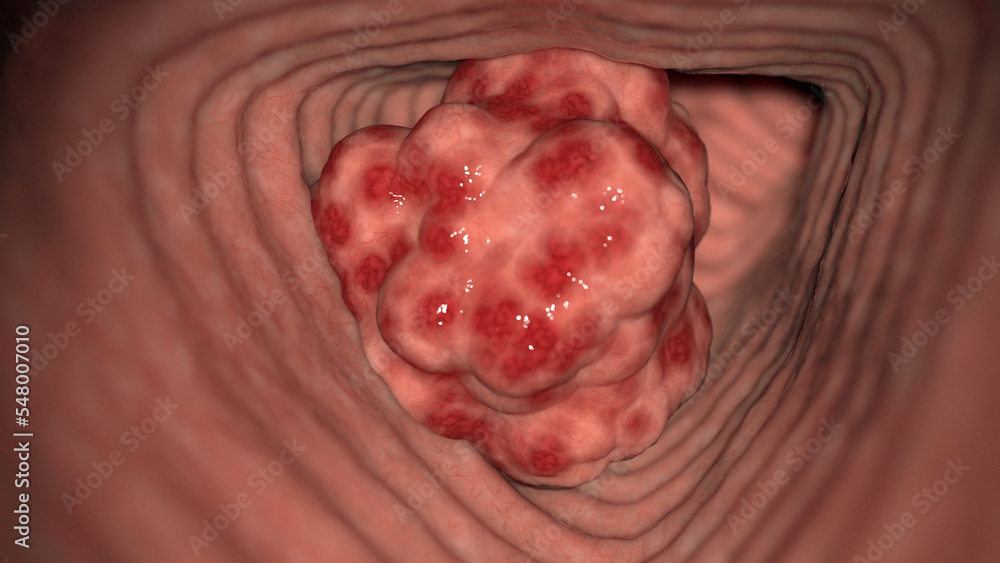 Fototapeta premium 3D Rendered Medical Illustration of Colon Cancer