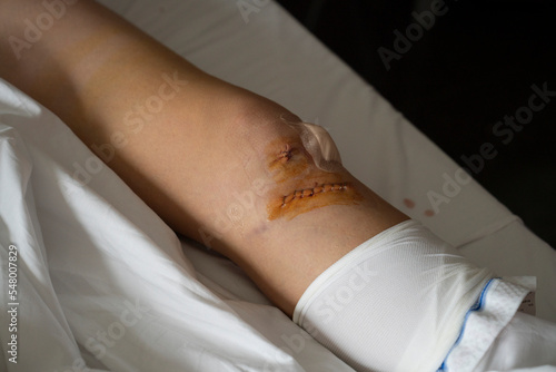 Wound from a cruciate ligament and meniscus operation closed with surgical staples