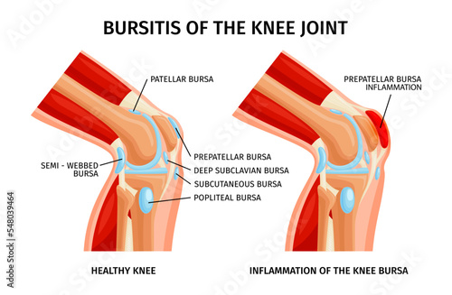 Knee Joint Bursitis Infographics