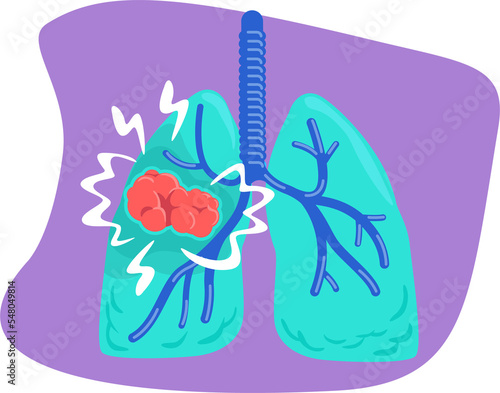 Lung cancer 2D raster isolated illustration. Diagnozing dangerous conditions flat sticker on cartoon background. Health complications colourful scene for mobile, website, presentation photo