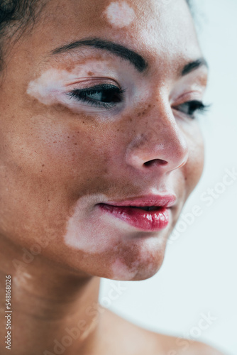 Beautiful woman with vitiligo skin posing in studio. Concept about body positivity and self acceptance