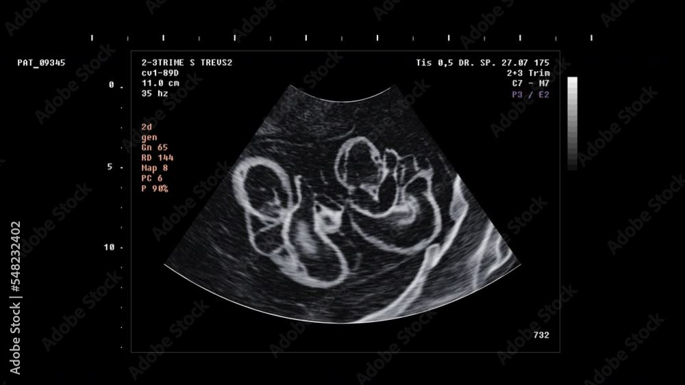 Twin Babies Discovered By Pregnancy Scanner Monitor. Analysis Of