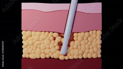 Conceptual Liposuction Treatment