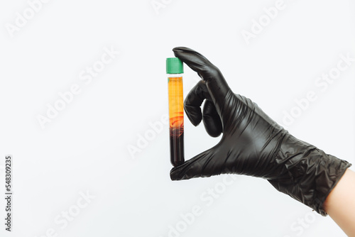 A doctor wearing gloves holds a test tube with blood and plasma in his hand. A syringe with platelet-rich plasma. Beauty Injection