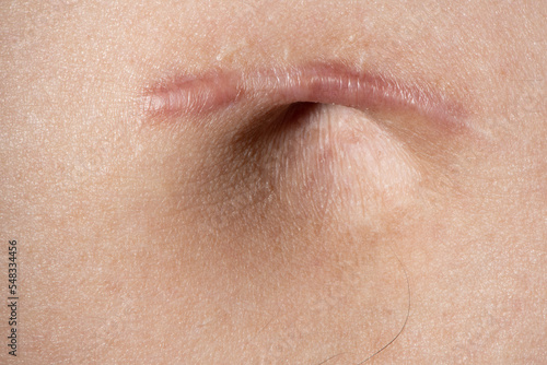 scar from umbilical hernia surgery photo