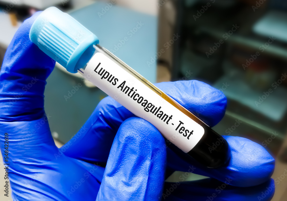 Blood Sample for Lupus Anticoagulant (LA). Blood coagulation testing