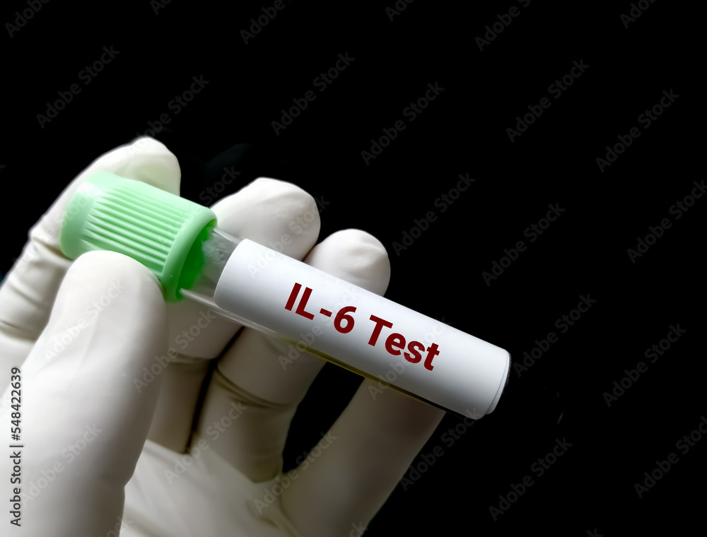 Blood sample for Interleukin 6 or IL-6 test, inflammatory cytokine, anti inflammatory myokine