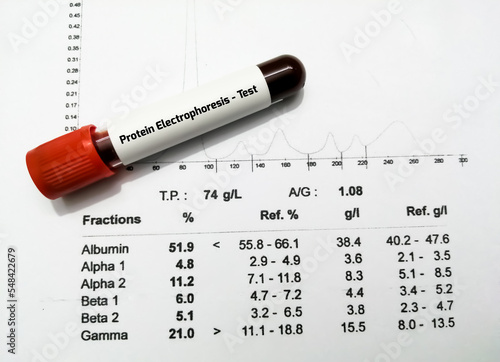 Blood sample and patient's report isolated for Protein Electrophoresis test. Close up. photo