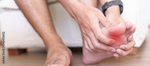 Bilde på lerret man having bunion toes or blister due to wearing narrow shoes and waking or running longtime, barefoot pain due to Plantar fasciitis