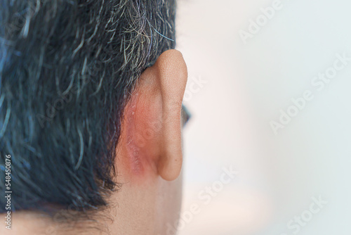 Man having ear problems due to Seborrheic dermatitis, psoriasis, ringworm and fungal skin infection photo