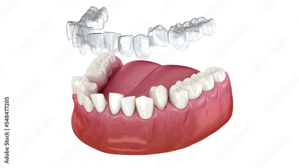 Invisalign braces or invisible retainer make bite correction. Medically accurate 3D animation Invisalign braces or invisible retainer make bite correction. Medically accurate 3D animation