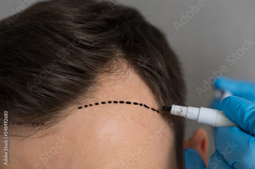 Hands of specialist in rubber gloves make marks on forehead of man on grey background. Male patient prepares for hair transplant surgery closeup