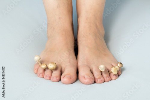 Fungi grow between the toes on the feet. Concept of nail fungus, skin and nail infections. Close-up of female feet with mushrooms growing between toes.