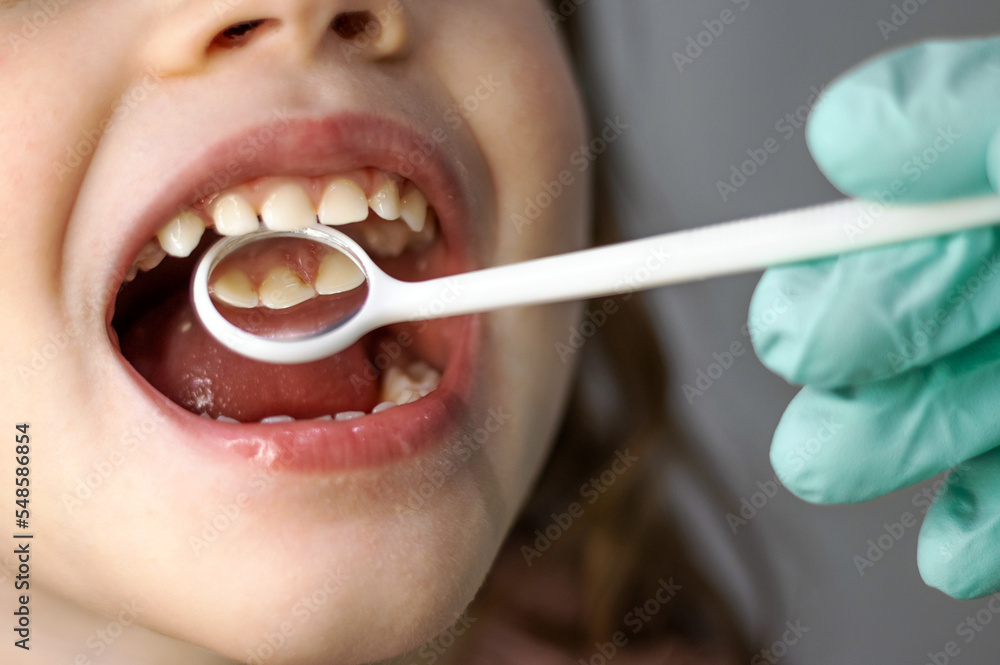 doctor dentist checking little girl teeth with dental inspection mirror