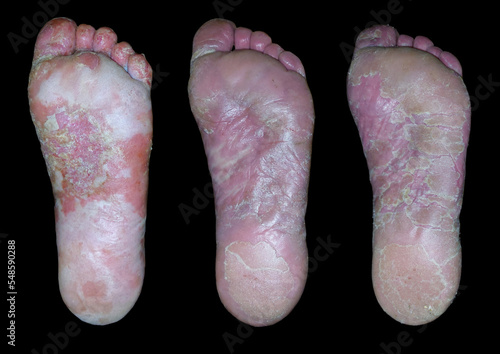 Treatment of allergic skin disease in three pictures.