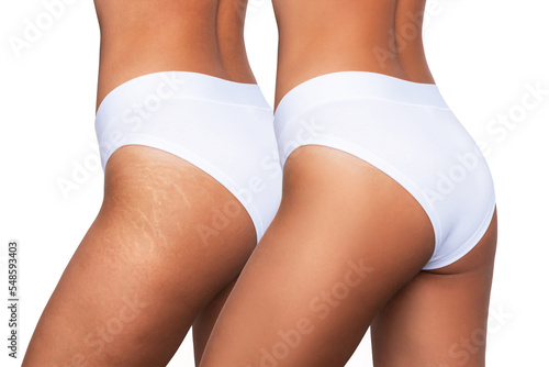 Cropped shot of young woman with white stretch marks from weight loss or weight gain on her thigh before and after laser removal procedure on white background. Result of treatment. Cosmetology, beauty
