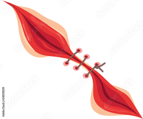 Skin cut wound with surgical stitches. Red mark