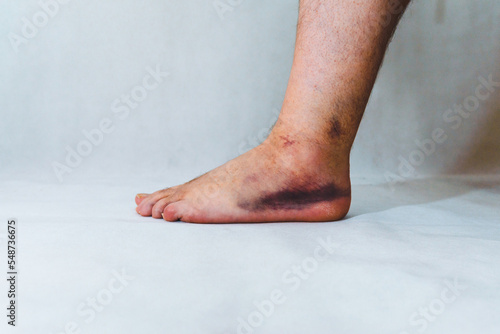 Fotografie Sprained and swollen ankle