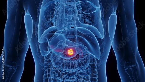 3d rendered medical animation of a pancreatic carcinoma in a human male