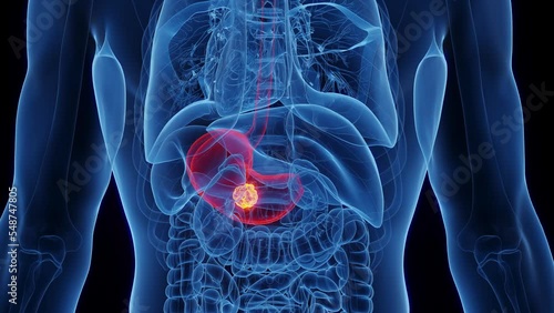 3d rendered medical animation of a cancerous mass in a man's stomach