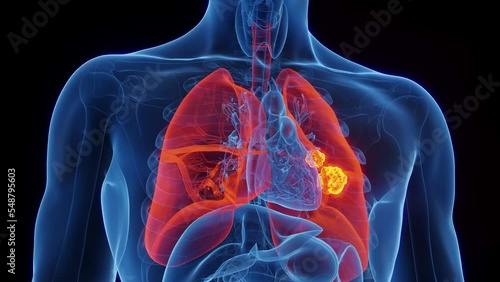 3d rendered medical animation of lung cancer in a human male