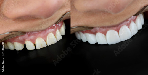 Fotografia smile makeover porcelain laminated veneers result